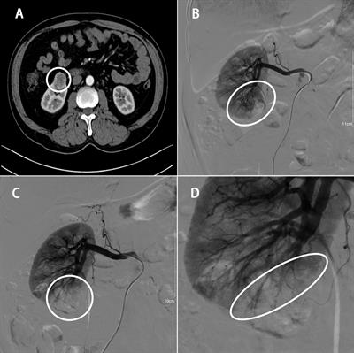 Clinical application of superselective transarterial embolization of renal tumors in zero ischaemia robotic-assisted laparoscopic partial nephrectomy